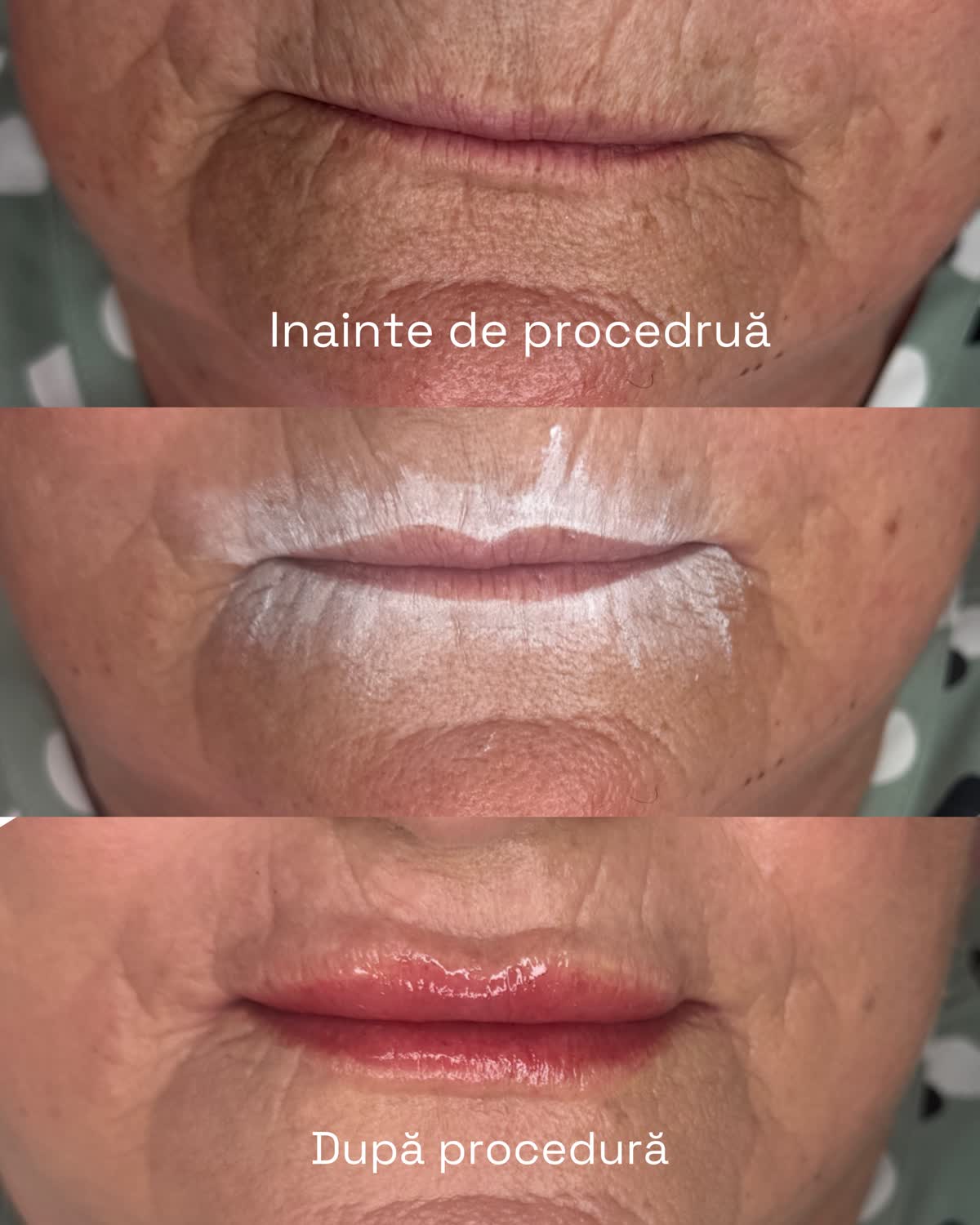 Micropigmentare buze – before after